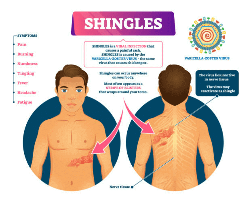 What is Shingles and why every senior citizen must get vaccinated against it?